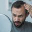 Hair Transplant Options Available for Balding Men