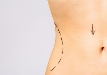Considering CoolSculpting to Remove Fat Deposits