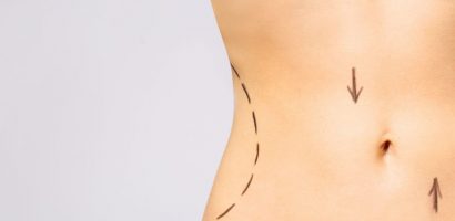 Considering CoolSculpting to Remove Fat Deposits
