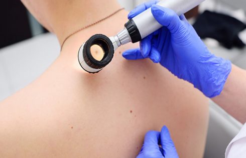 How To Recognize Potential Melanoma