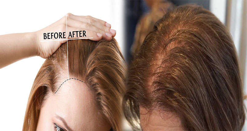 How to Regrow Thinning Female Hair