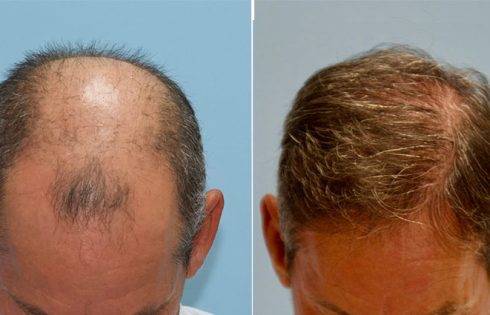 What is a Fue Hair Transplant?
