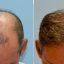 What is a Fue Hair Transplant?