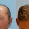 What is a Fue Hair Transplant?