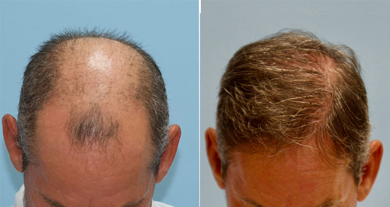 What is a Fue Hair Transplant?