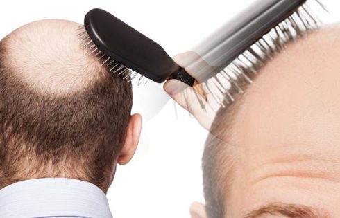 Here are the Top 4 Potential Causes of Hair Loss and Baldness