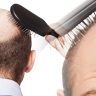 Here are the Top 4 Potential Causes of Hair Loss and Baldness