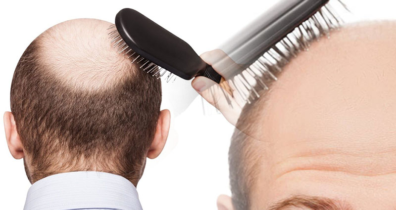 Here are the Top 4 Potential Causes of Hair Loss and Baldness